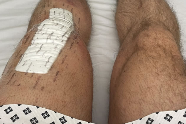 Steve had experiences several painful years before the surgery on his knee